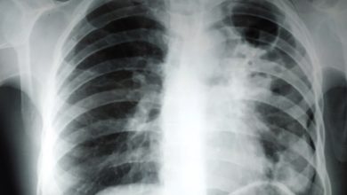 Timely treatment is necessary instead of hiding TB