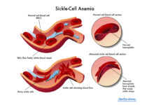 Hydroxyurea approved for treatment of sickle cell anemia